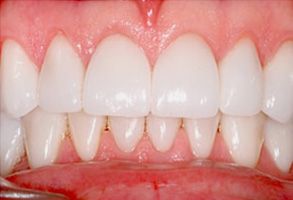 Louis Sinatra | Dentures, Laser Dentistry and TMJ Disorders