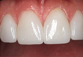 Louis Sinatra | Teeth Whitening, Veneers and Dental Bridges