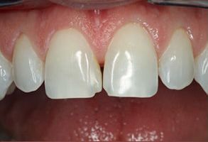 Louis Sinatra | Dental Cleanings, Teeth Whitening and All-on-6 reg 
